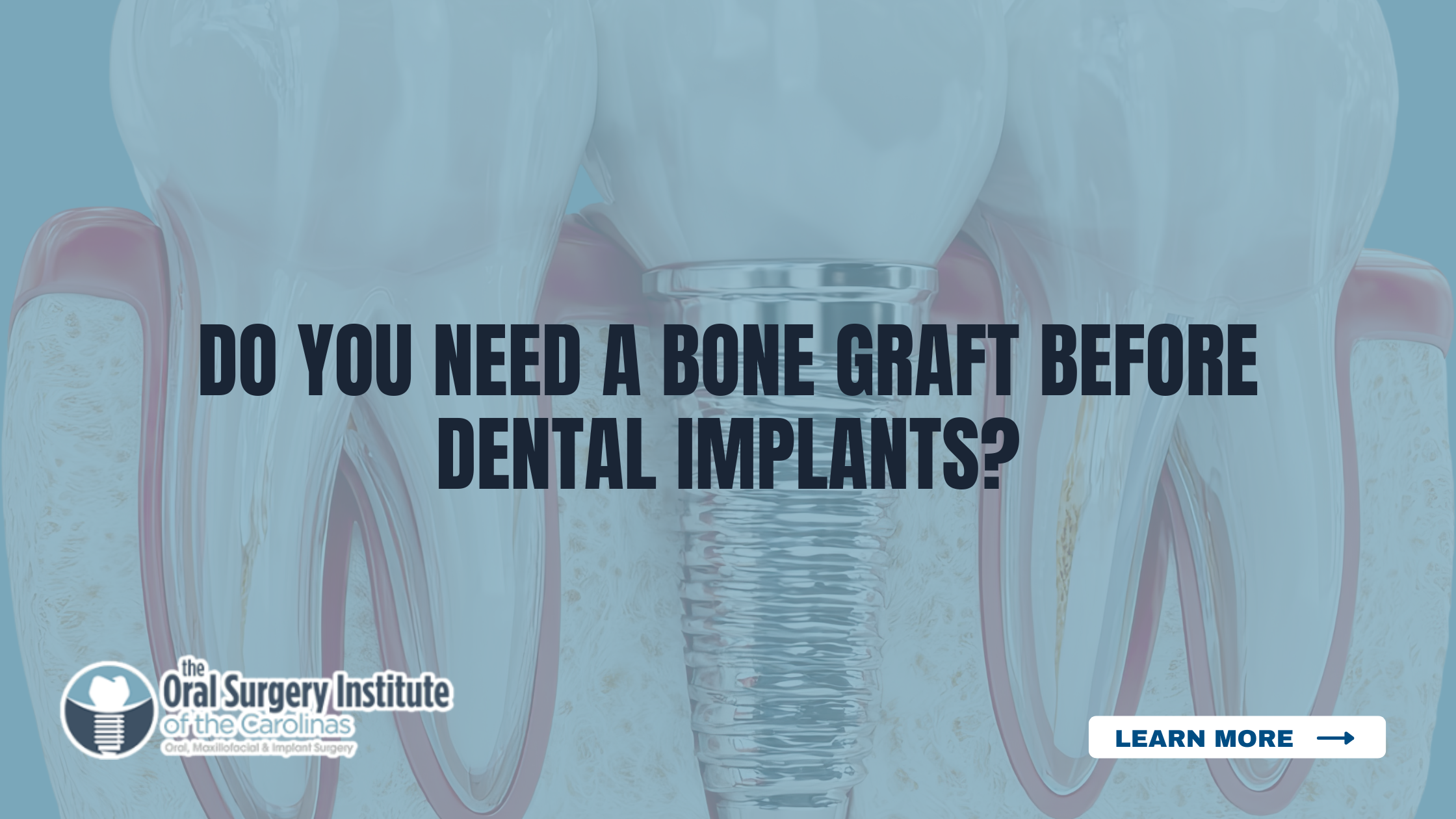 Do You Need a Bone Graft Before Dental Implants